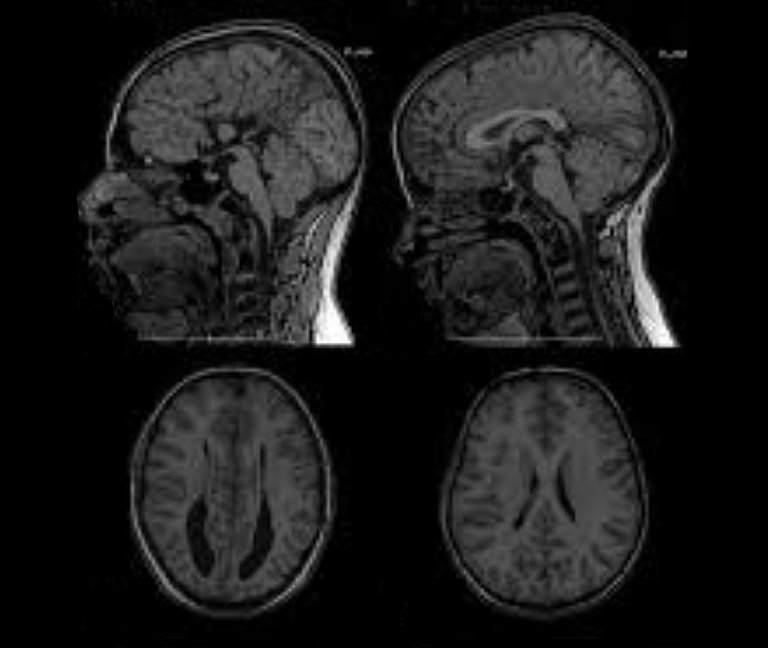 MRT vom Gehirn, Überdrainage, Schlitzventrikel, Hydrocephalus